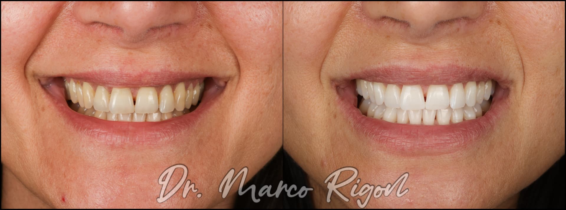 Sorriso di Chiara prima e dopo lo sbiancamento dentale, a confronto