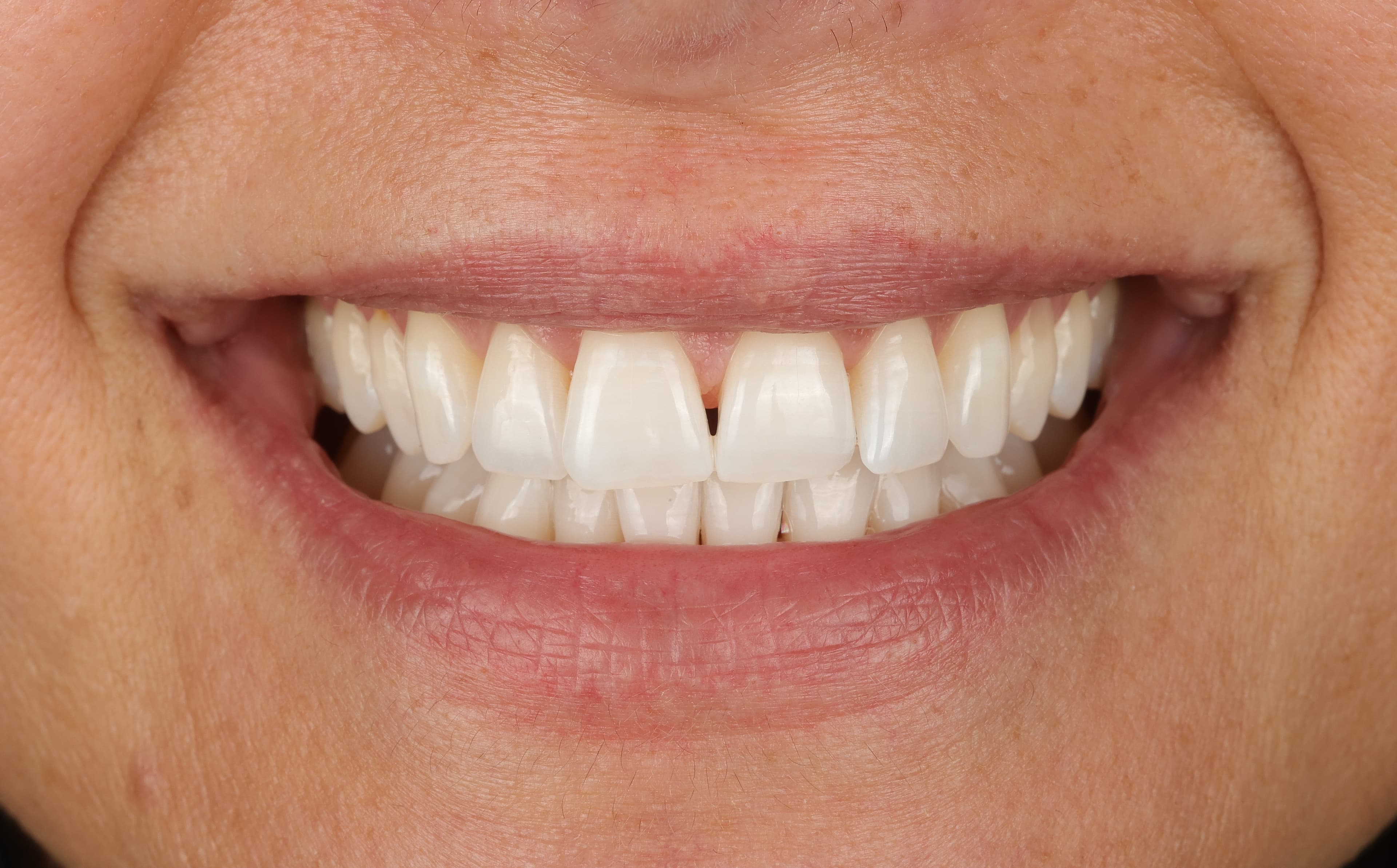 Sorriso di Chiara dopo lo sbiancamento dentale